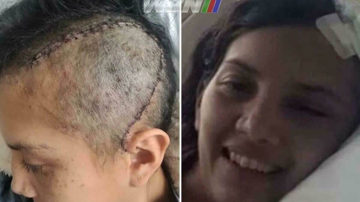 Alejandra Ayala recovery stitches